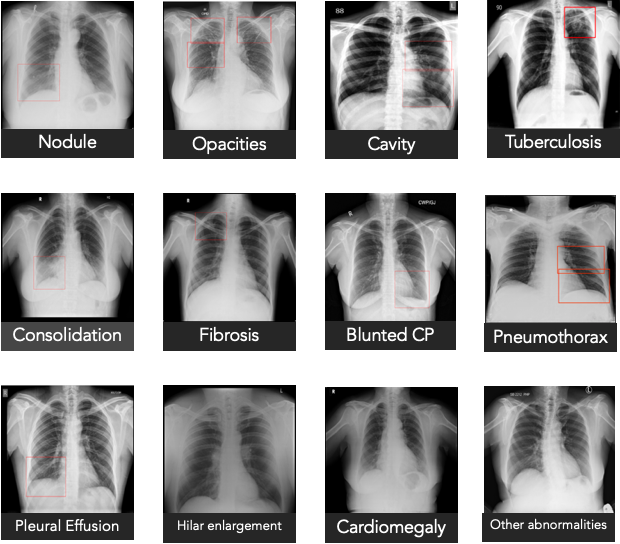 A screenshot of the types of lung abnormalities that Qure.ai's qXR system can detect.