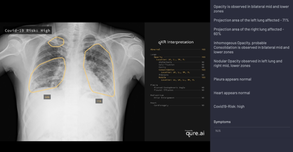 Qure.ai's qXR system highlights the lung abnormalities in a chest X-ray scan and explains the logic behind its covid risk evaluation.