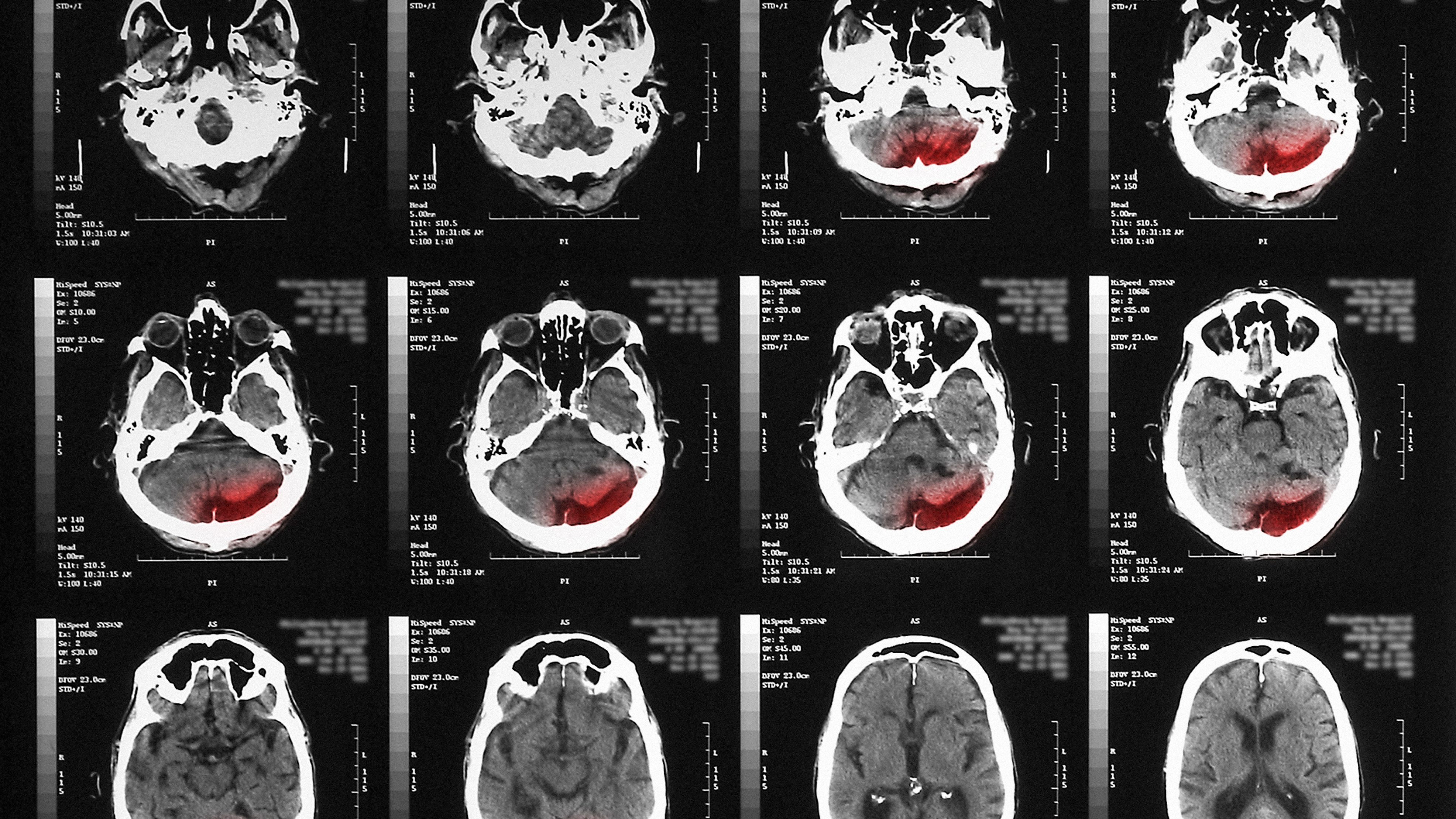 CT scan of elderly man with old occipital infarct