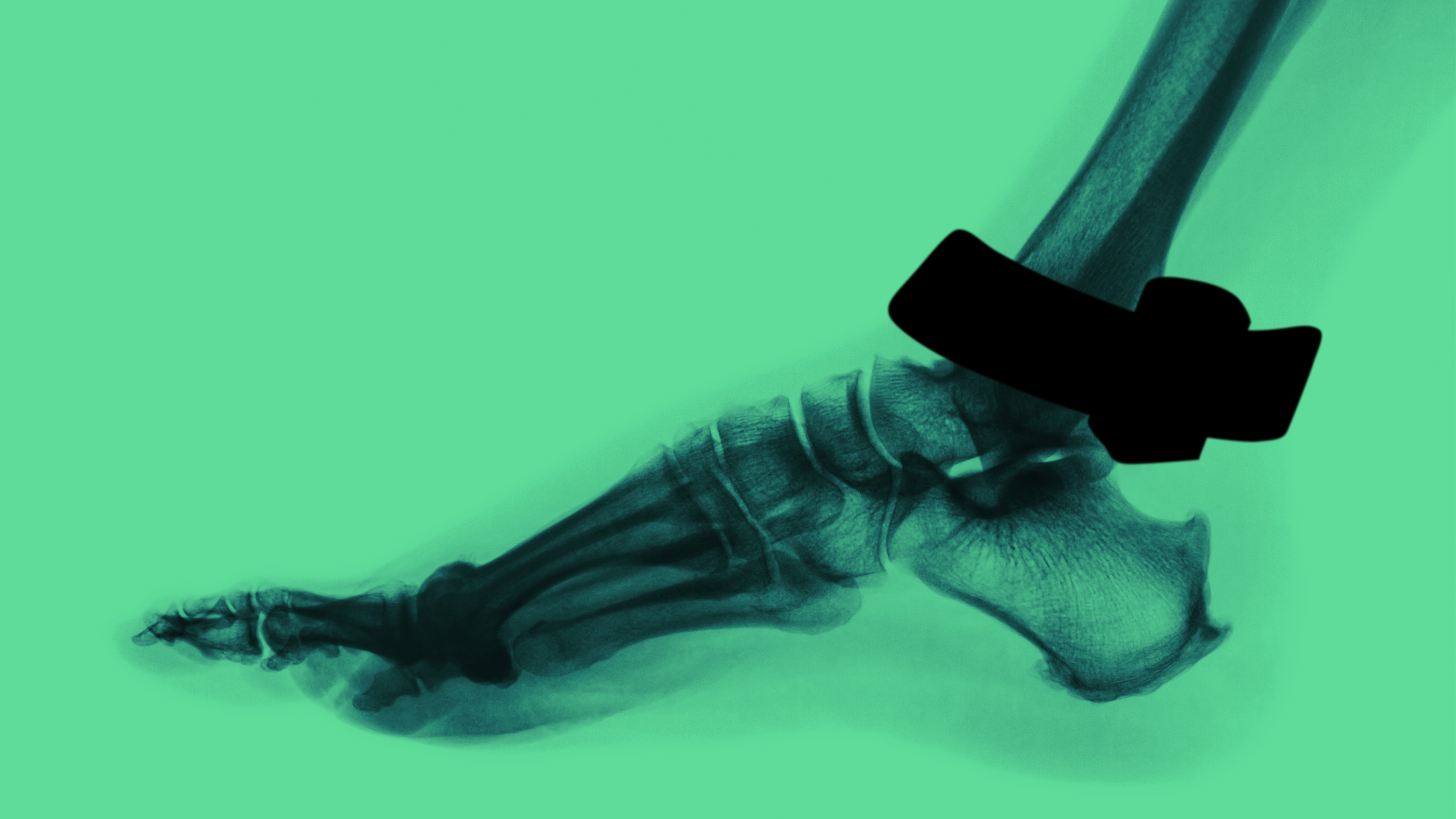 x-ray view of ankle with ankle monitor