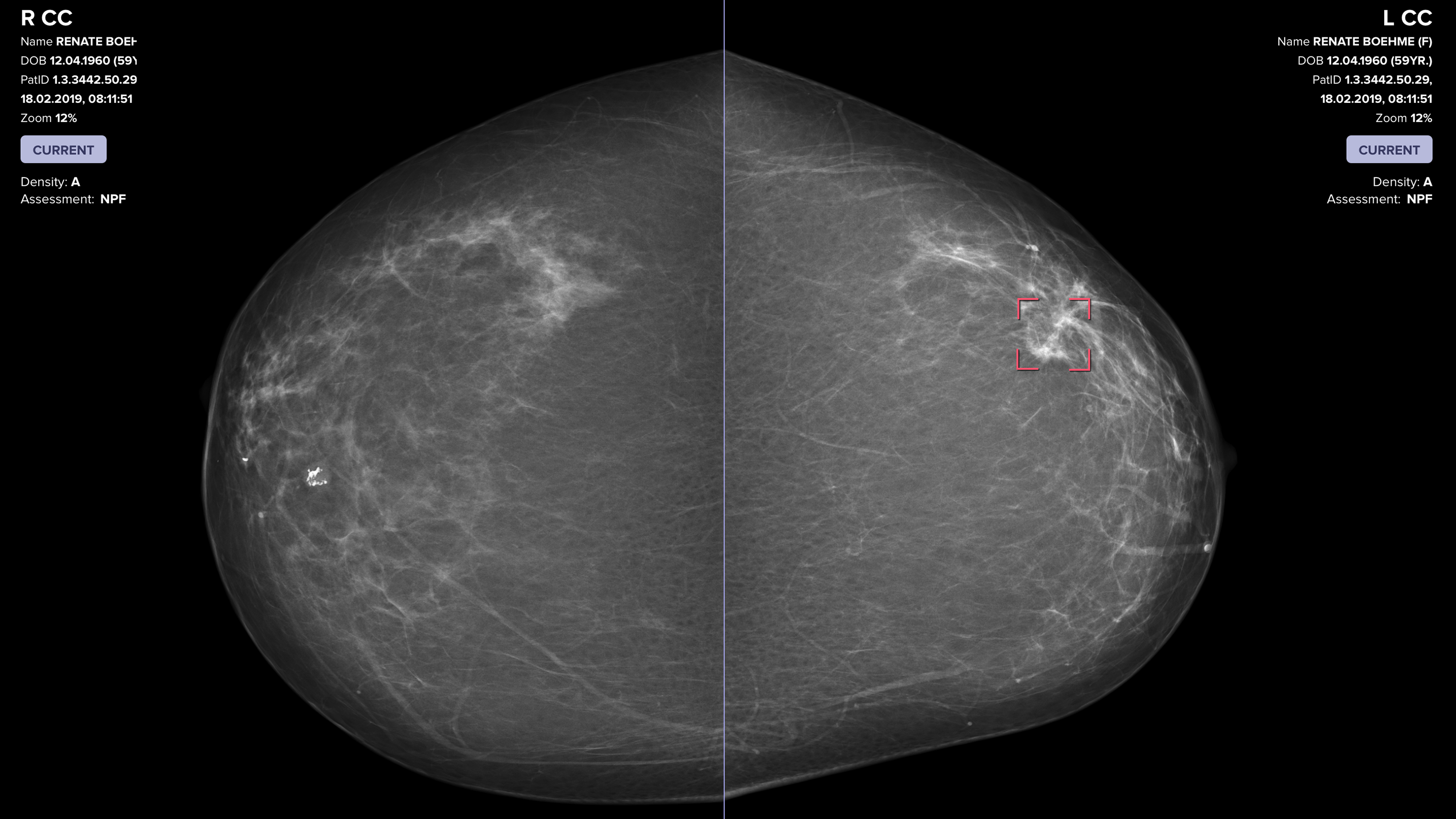 sample image of breast scan analyzed by AI
