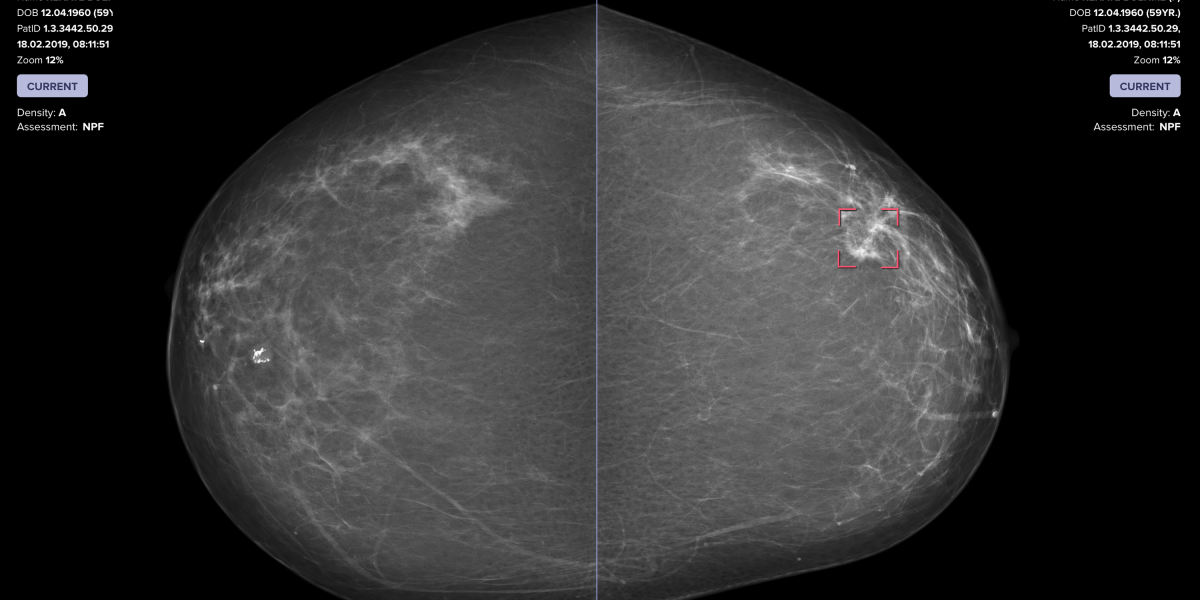Ärzte, die KI verwenden, erkranken häufiger an Brustkrebs als entweder allein