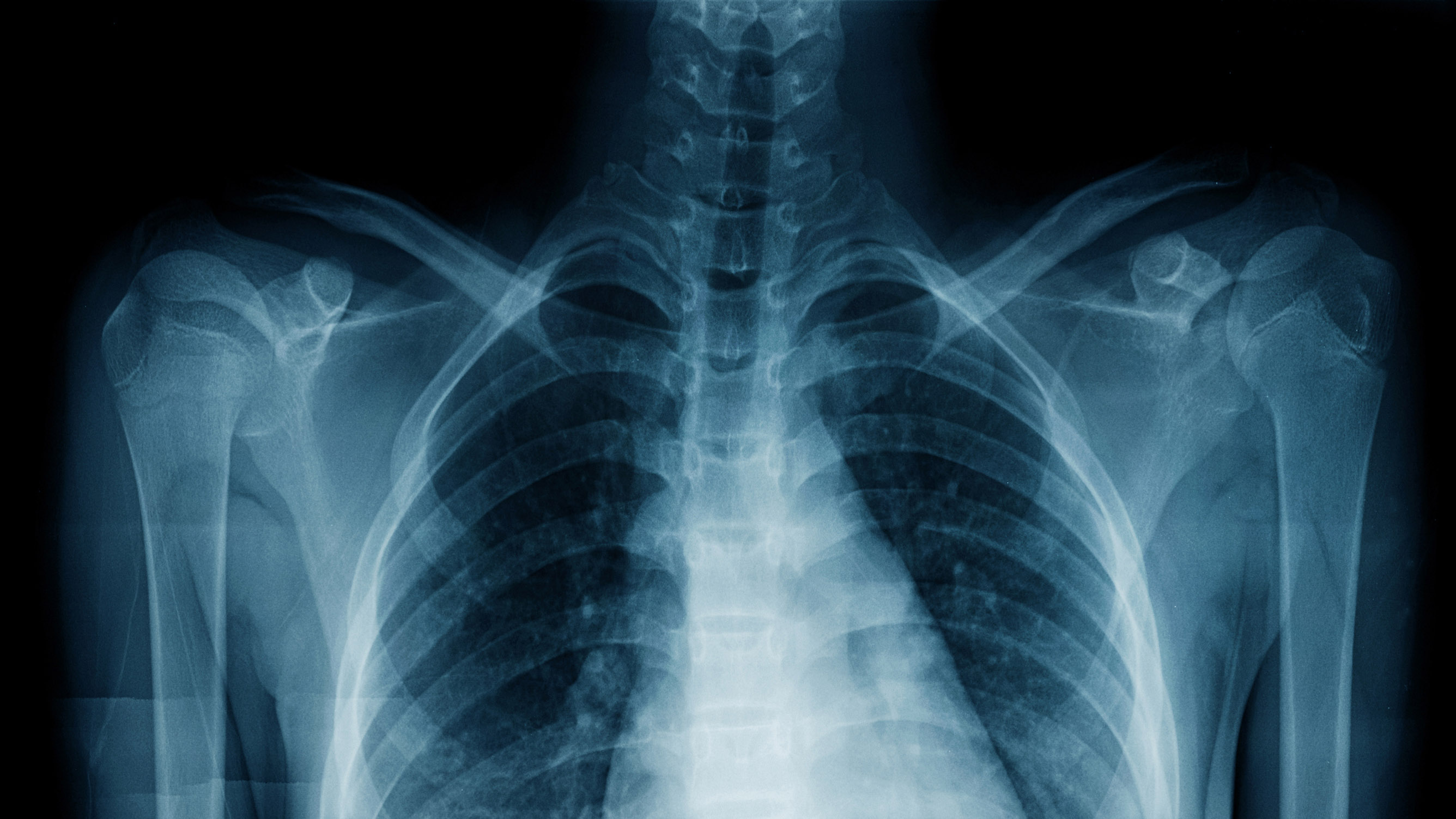 Close-Up Of Chest X-Ray