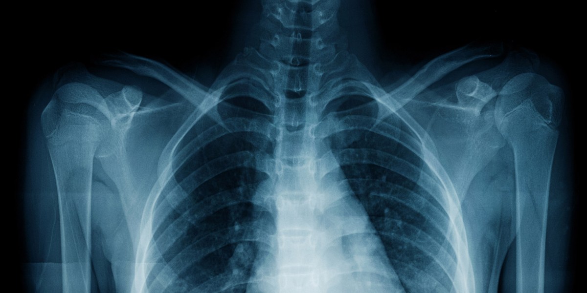 ИИ использовал медицинские заметки, чтобы научиться распознавать болезни на рентгенограммах грудной клетки