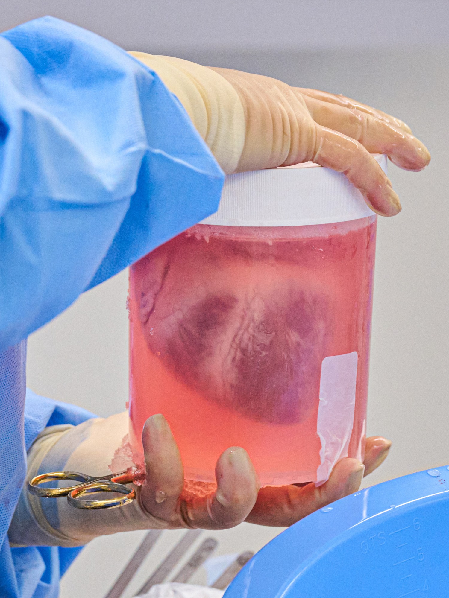 Las manos enguantadas de un médico sostienen un frasco que contiene un corazón.