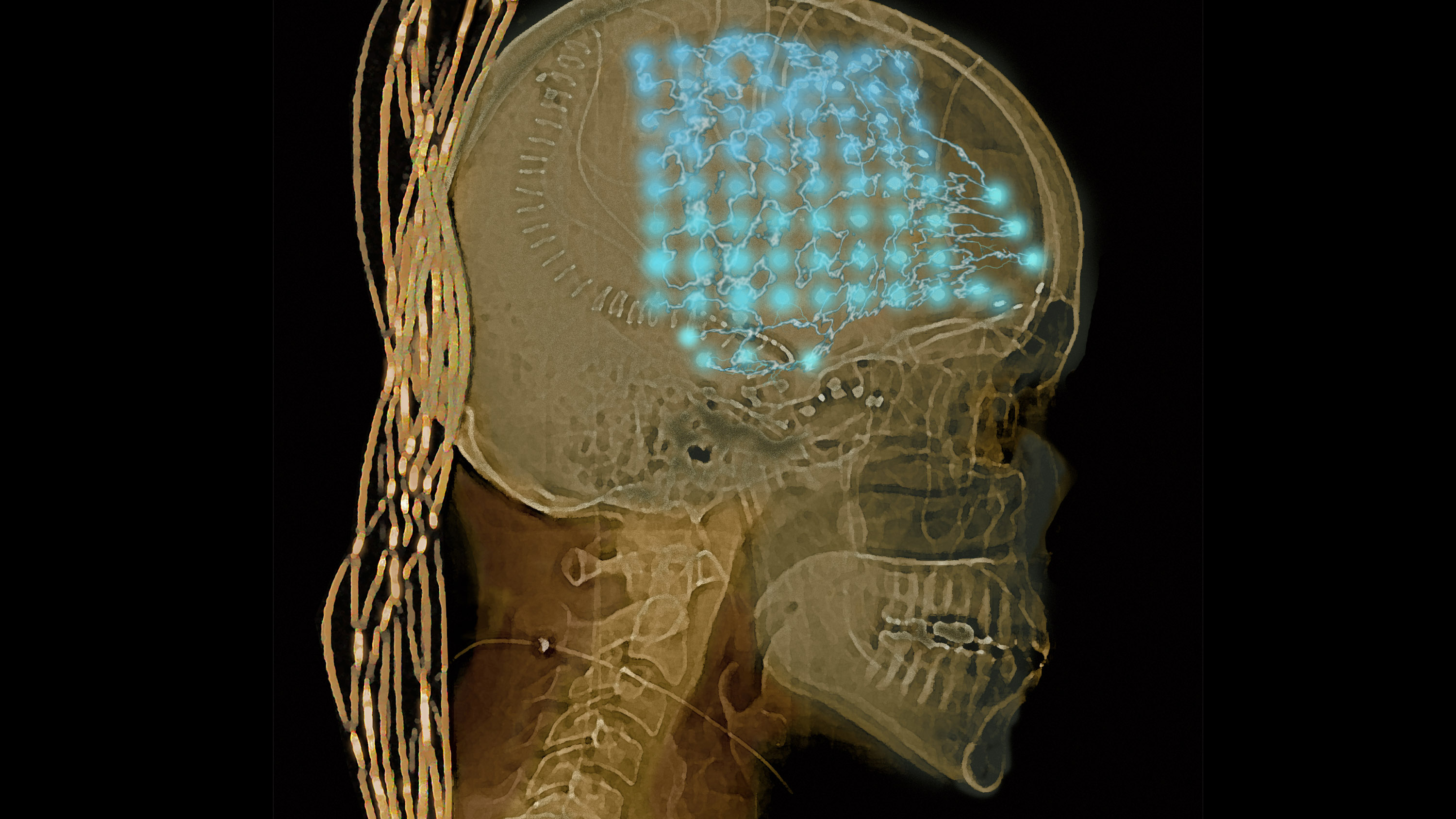 CT scan with blue pattern to represent electrodes in the brain