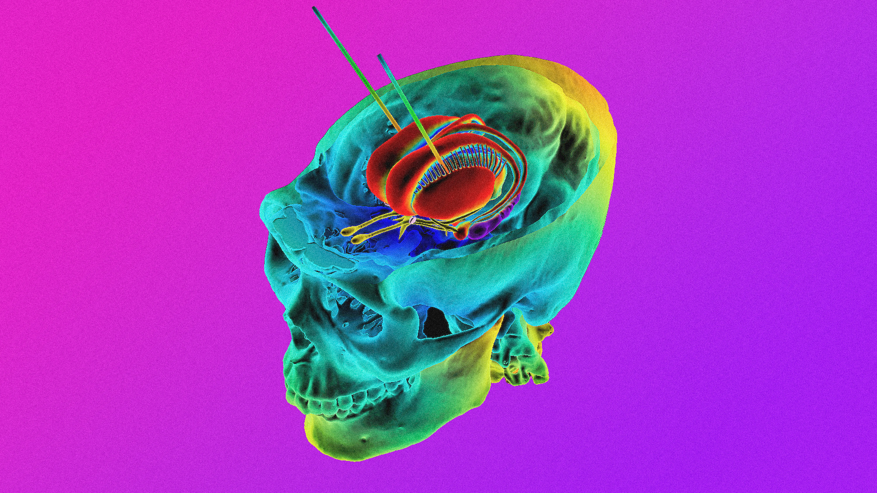 3D image based on computed tomography (CT) scans showing skull and the limbic system of the brain being stimulated by the neurosurgical treatment deep brain stimulation (DBS)