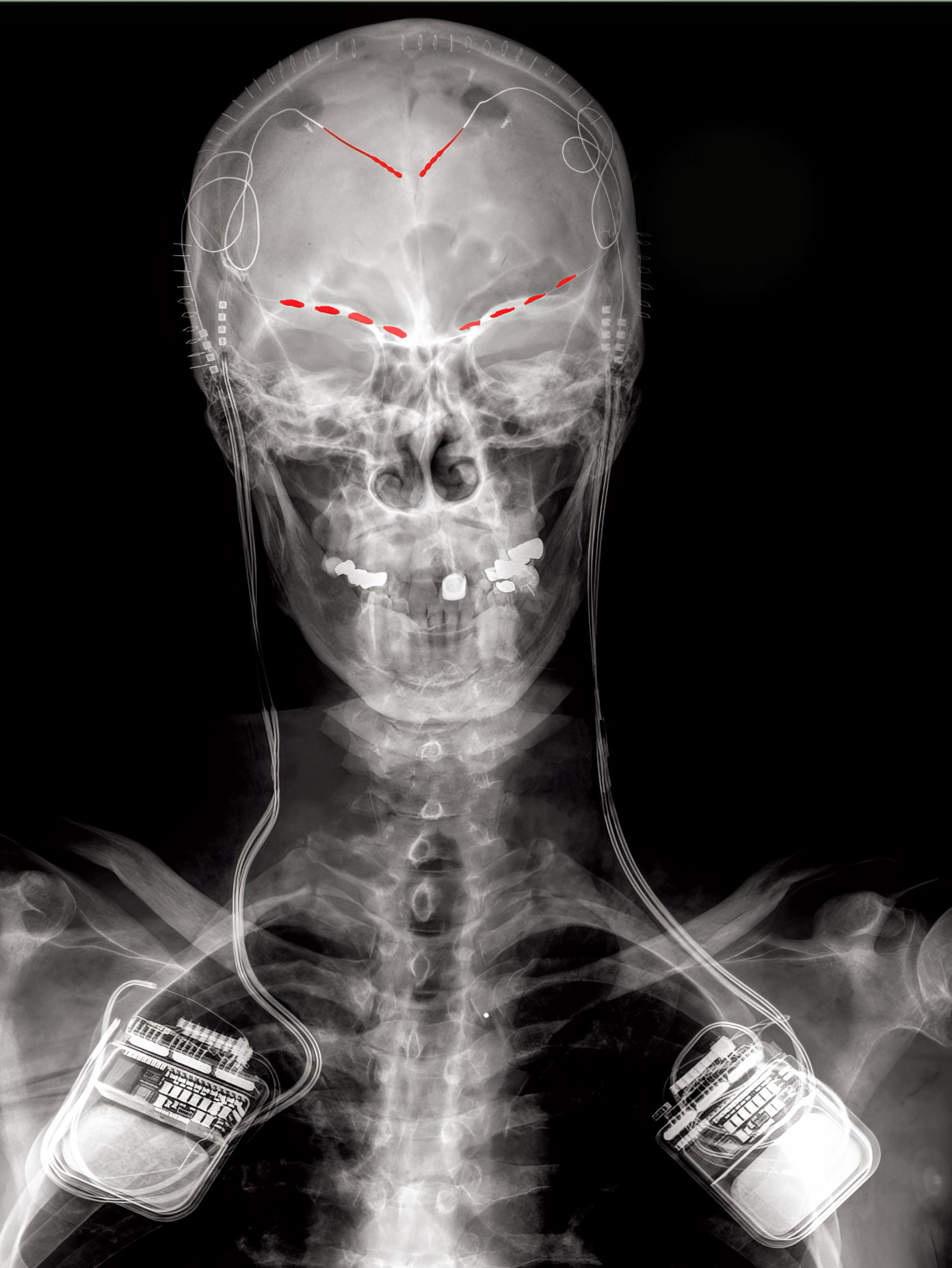scan of a patient with sensors embedded in head (highlighted in red) and wires connecting down to two receivers on chest