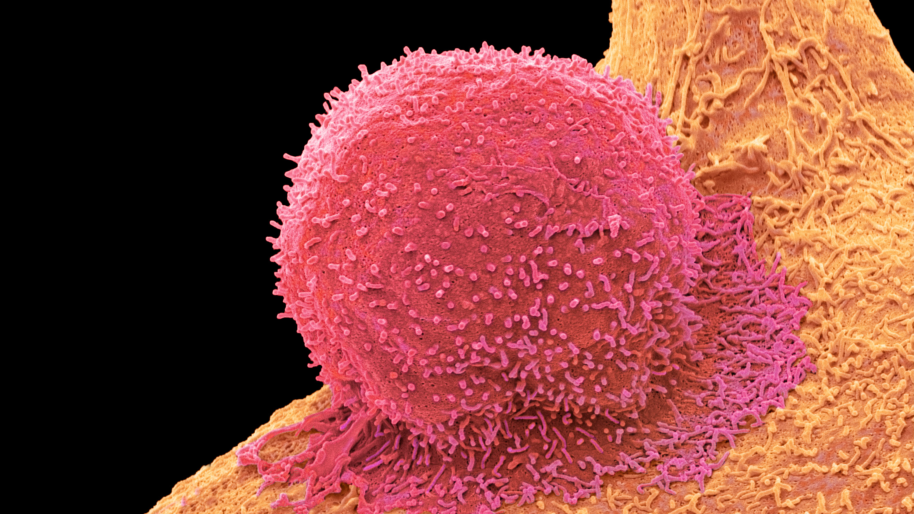 CAR T-cell therapy. Colored scanning electron micrograph (SEM) of a T-cell (red) and a breast cancer cell.