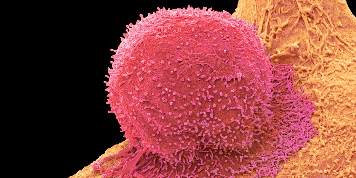 You are currently viewing Progressive new cell therapies might lastly get at tough-to-target cancers