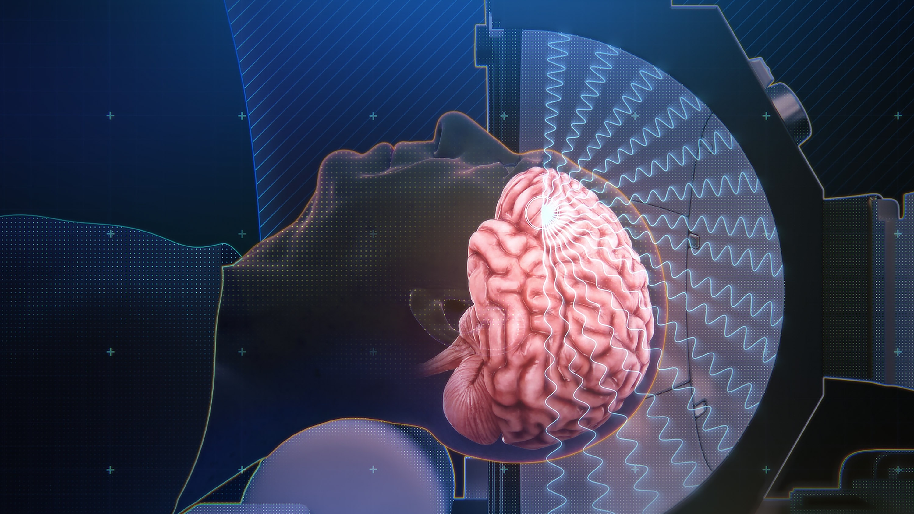 a patient rendered in profile with brain image superimposed on their head which is partially inside a machine. Wavy lines representing ultrasound waves radiate onto the brain from the half-circle interior of the machine